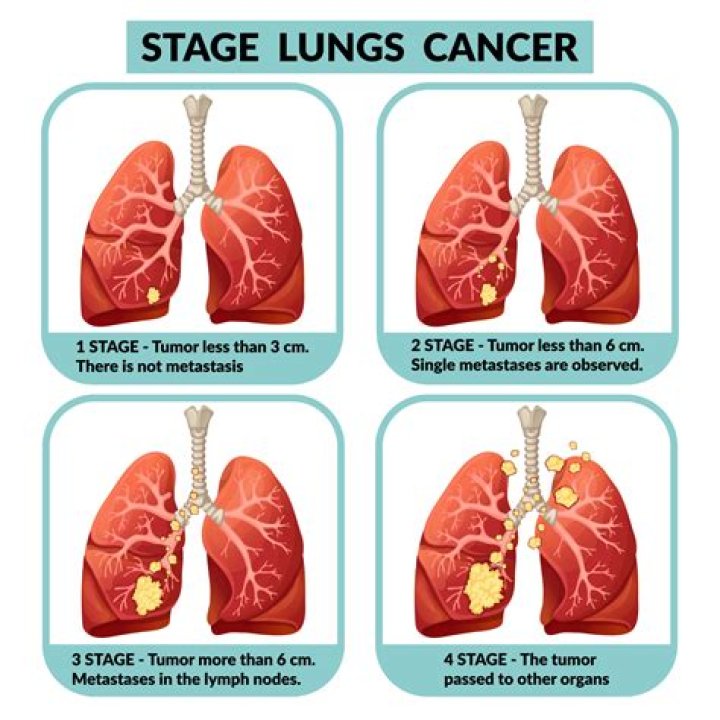 4th Stage Lung Cancer Mike Murillo's Health Update