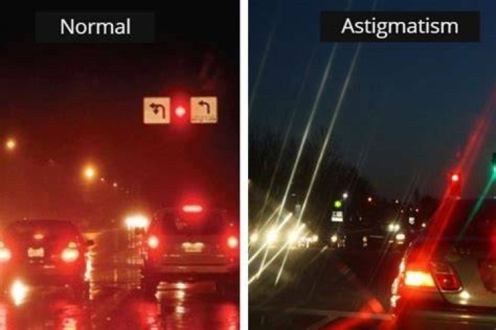A Complete Guide to Astigmatism Symptoms, Causes, Diagnosis, and
