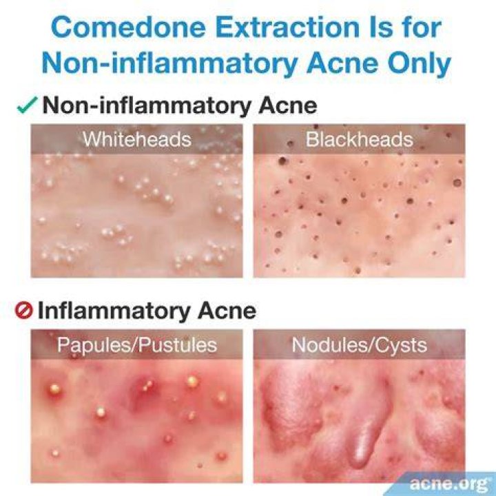 Are comedone extractors bad for your skin?