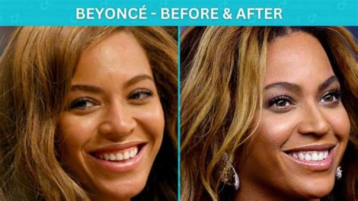 Before And After Cosmetic Enhancements