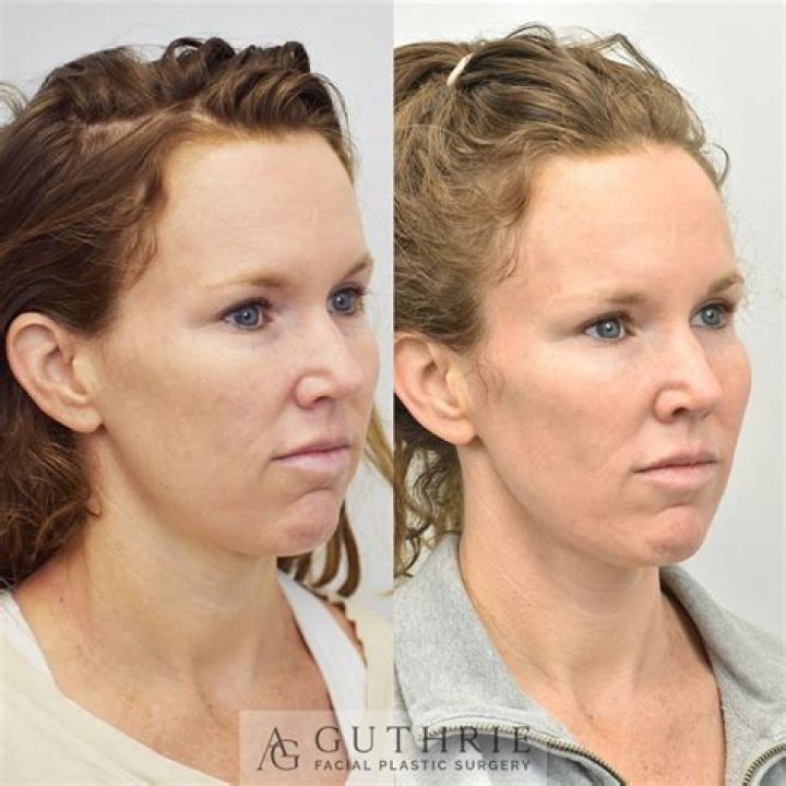 Before and After Facetite Photo Gallery Brent Moelleken M.D.