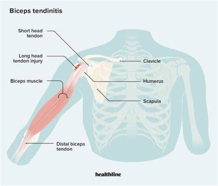 Biceps Muscle Injuries