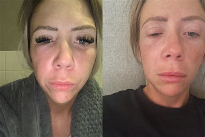 Botox Gone Wrong! Woman's Lips Left Swollen After Getting Fillers From