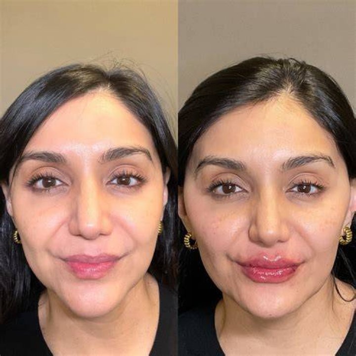 BOTOX&reg; Cosmetic Before & After Photos Patient 47 Houston, TX