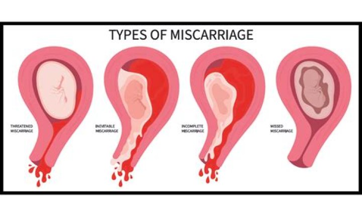 Can Crocin cause miscarriage?