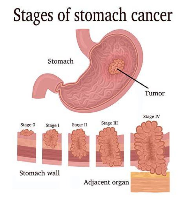 Can stomach cancer be treated successfully?