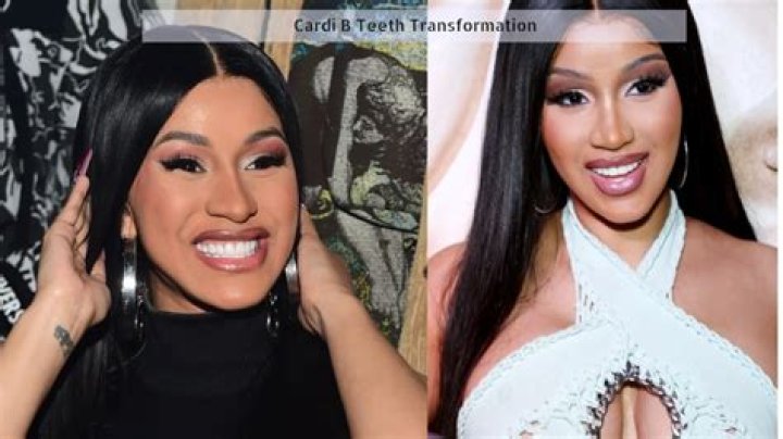 Cardi B's Teeth Cost Revealed!