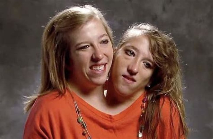 Conjoined Twins Abby And Brittany Boyfriend
