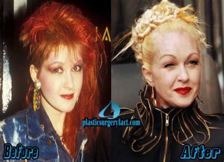 Cyndi lauper plastic surgery Cyndi Lauper Plastic Surgery Before And
