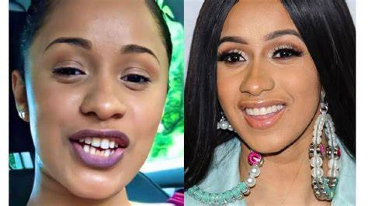 Did Cardi B Get Her Teeth Fixed? See BeforeandAfter Pictures