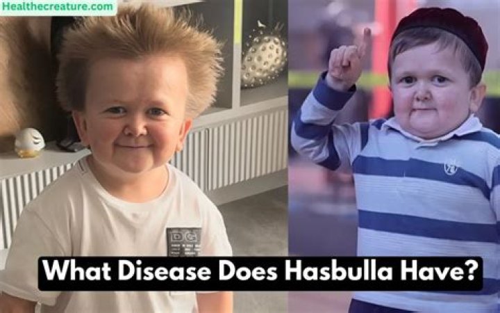 hasbulla disease Archives Newsone Nigeria