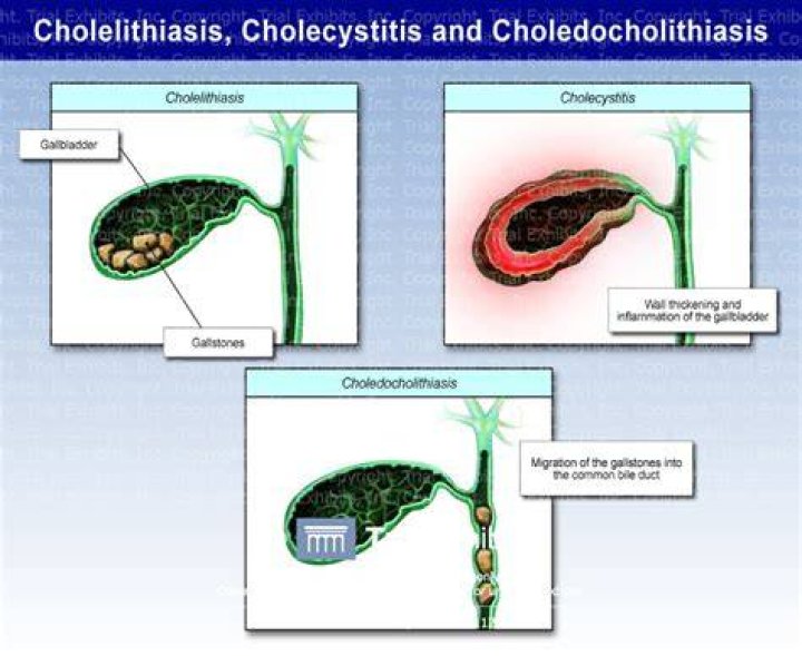 How can you tell the difference between cholelithiasis and cholecystitis?