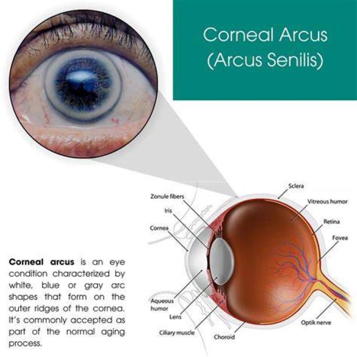 How do you get rid of Arcus Senilis naturally?
