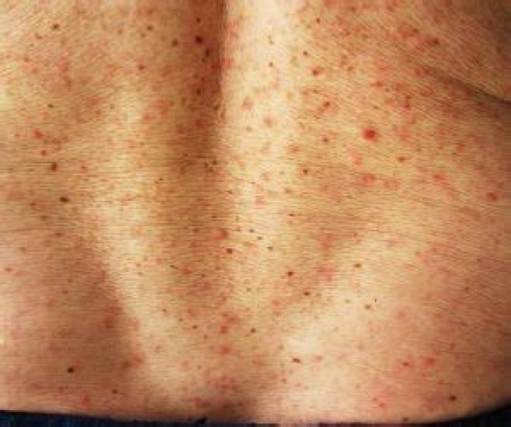 INDOOR ENTOMODERMATOSES TYPICAL LESIONS Perprin S.r.l. All rights
