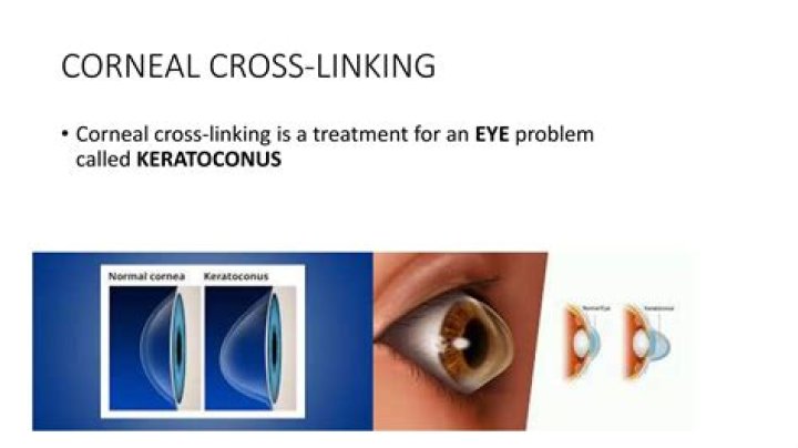 Is corneal cross linking worth it?
