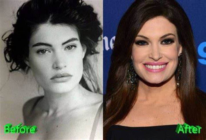 Kimberly Guilfoyle Plastic Surgery Facelift, Breast Enlargement, Botox
