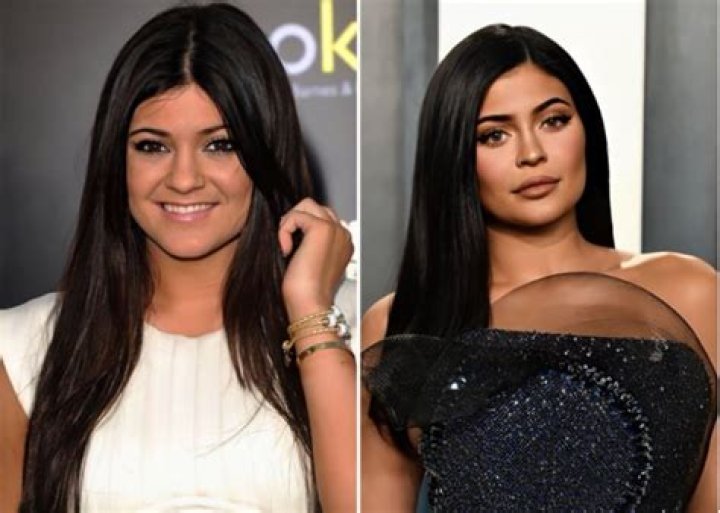 Kylie Jenner Before And After Weight Loss