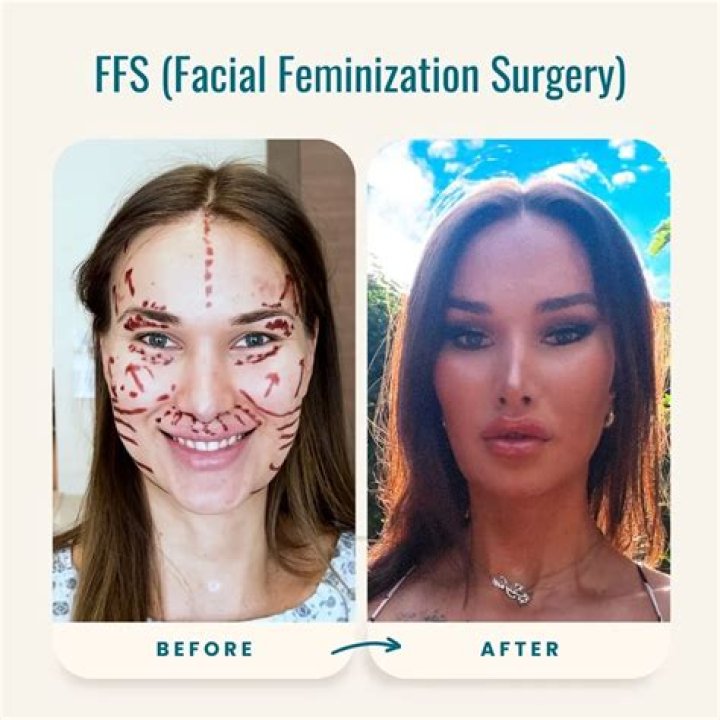 Leila before and after FFS 2pass Clinic