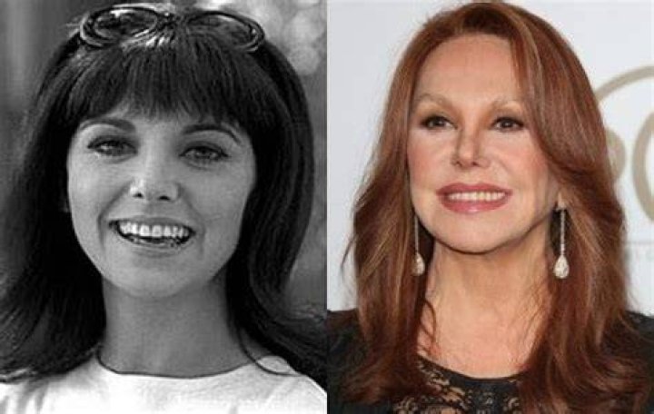 Marlo Thomas Plastic Surgery Nose Job Before and After Facelift, Botox