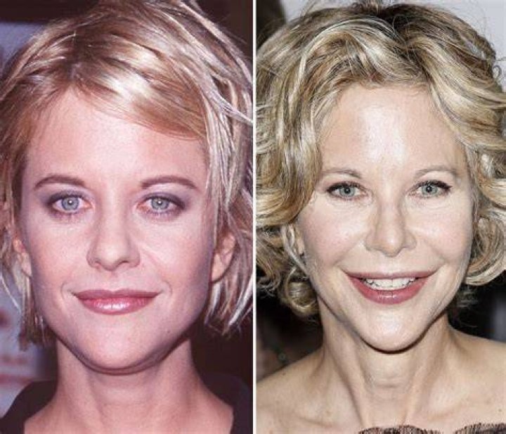 Meg Ryan Evolution in Plastic Surgery