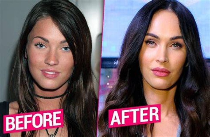 Megan Fox Plastic Surgery Transformation Revealed By Top Doctors