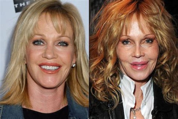 Melanie Griffith's Plastic Surgery Journey