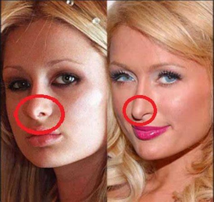 Paris Hilton Nose Job Plastic Surgery Before And After Rhinoplasty
