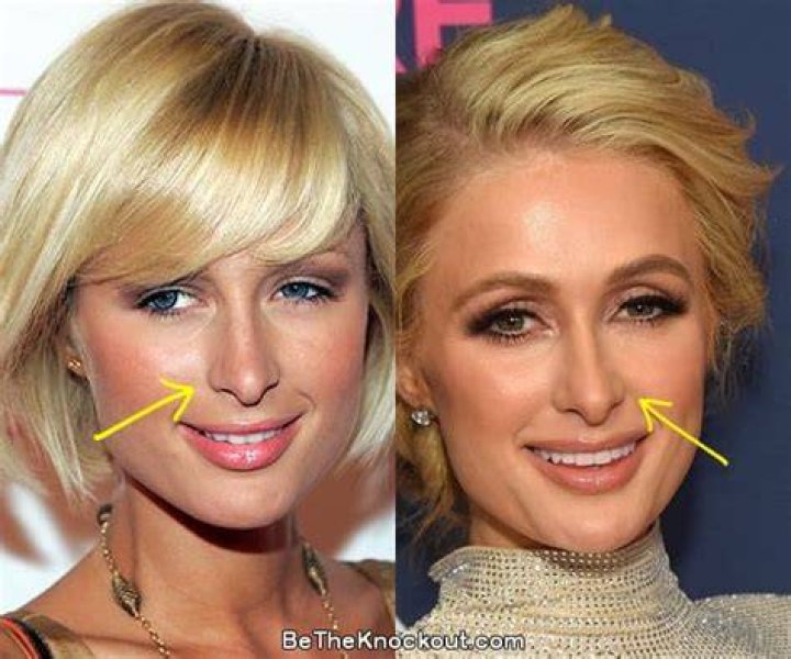 Paris Hilton Plastic Surgery Myths Microcurrent is What's Hot NewBeauty