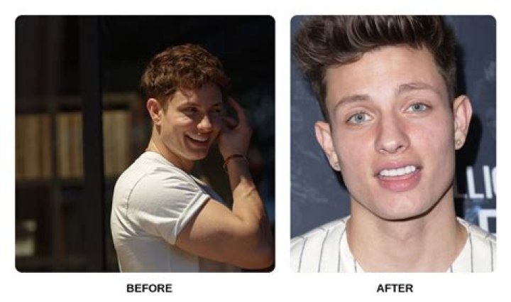 Revealing The Art Of Matt Rife's Teeth Veneers: Unlocking A Brighter Smile