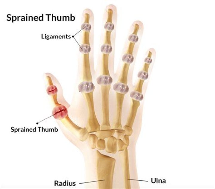 Sprained Thumb Cause and Recovery Time OrthoIndy Blog