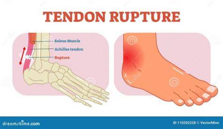 Tendon rupture anatomical example illustration VectorMine