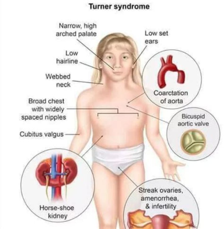 Turner Syndrome Q & A (2nd Edition) YouTube