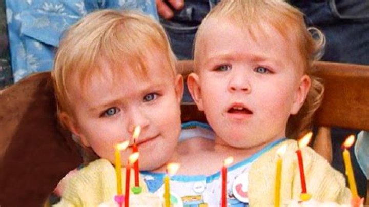 Two Heads, One Body Eilish Holton's Life After Seperating From Her