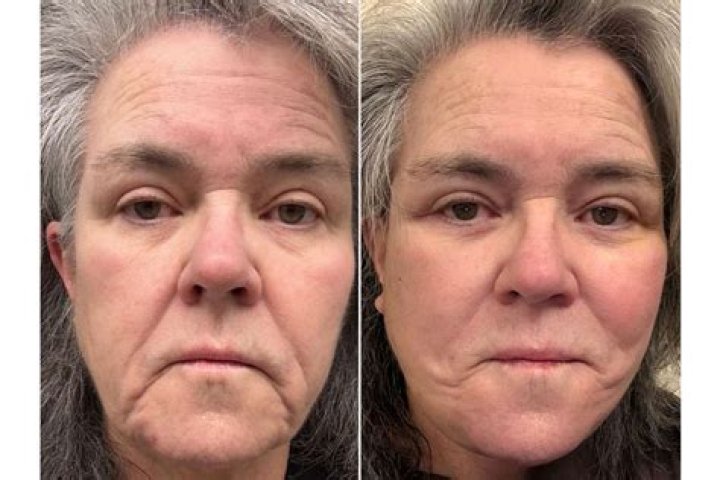 Unfiltered Before And After Revelations