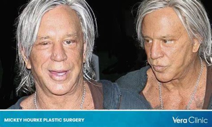 Unveiling Mickey Rourke's Plastic Surgery Odyssey: Discoveries And Insights