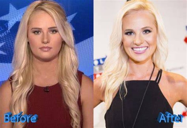 Unveiling Tomi Lahren's Transformation: A Journey Before Surgery