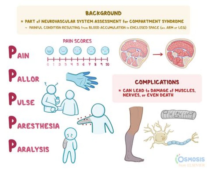 What are the 5 signs of compartment syndrome?