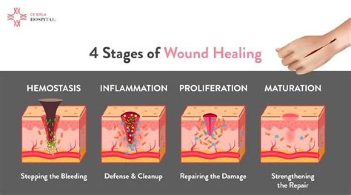 What are the steps to stitching a wound?