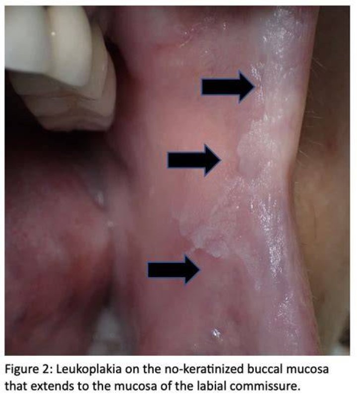 What does leukoplakia look like in the throat?