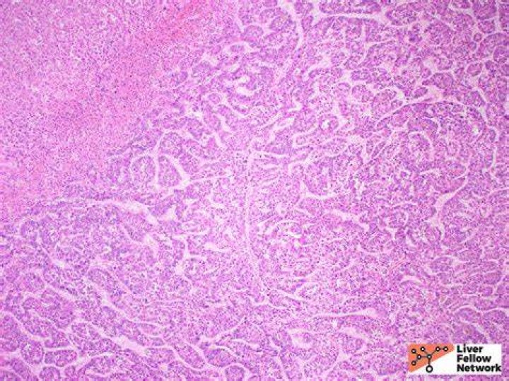 What is hepatocellular carcinoma PDF?
