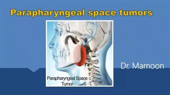 What is Parapharyngeal tumor?