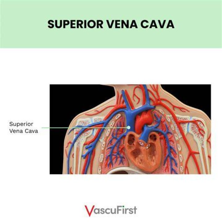 What is vena cava interruption?